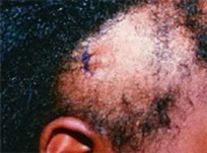 How does one get a scalp burn from a chemical relaxer?